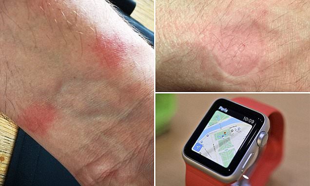 Apple Watch burned the wrist